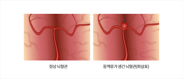 정상 뇌혈관 / 동맥류가 생긴 뇌혈관(화살표)