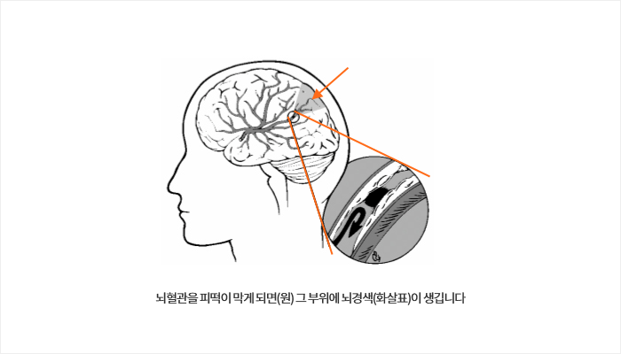 뇌혈관을 피떡이 막게 되면(원) 그 부위에 뇌경색(화살표)이 생깁니다